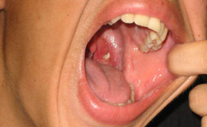 Выделение слизи из горла: симптоматика и способы лечения