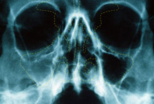 Гайморит на рентгеновском снимке: расшифровка рентгенограммы