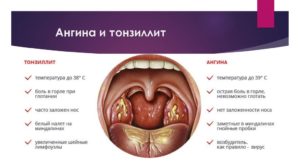 Причины возникновения боли в горле при глотании и методика лечения