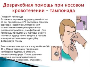 Полезные советы: что нужно делать при носовом кровотечении