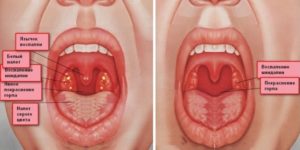Советы родителям: как лечить красное горло у грудничка