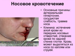 Частое кровотечение из носа: причины, медикаментозное и хирургическое лечение