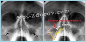 Рентгенография придаточных пазух носа: процедура и расшифровка снимка