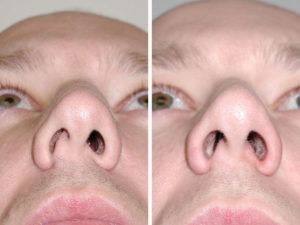 Последствия кривой перегородки носа и способы лечения патологии