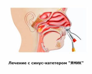 Особенности развития гайморита у беременных и безопасные методы лечения