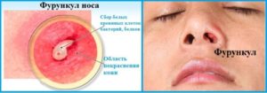 Основные симптомы стафилококка в носу и способы лечения инфекции