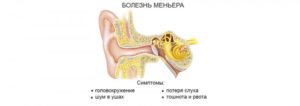 Лабиринтит воспаление внутреннего уха: признаки и способы лечения