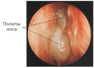 Полипы в носу: причины появления, стадии и лечение