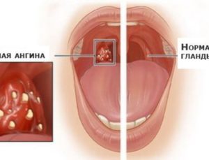 Особенности лечения болезней горла чем лечить в домашних условиях
