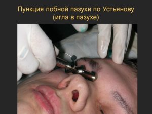 Прокол гайморовых пазух, лечение после прокола и возможные осложнения