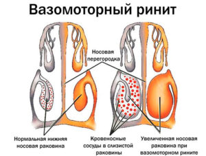 Как проявляется вазомоторный ринит и когда назначается операция?