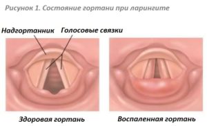 Что такое ларинготрахеит: все о болезни