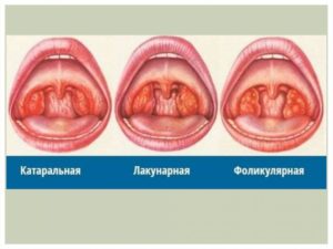 Катаральная ангина: лечение, симптомы и причины заболевания