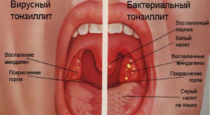 Герпес в горле: основные симптомы вирусной инфекции