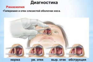 Как снять отек слизистой носа у ребенка самые эффективные и безопасные методы лечения