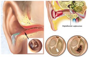 Свист в ушах: причины и возможные заболевания