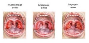 Сколько держится температура при ангине у детей, как и чем ее сбить?