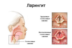 Хронический ларингит: симптомы и лечение, причины болезни