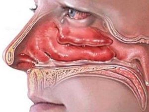 Признаки отека слизистой носа и лучшие противоотечные препараты
