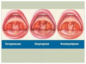 Бывает ли ангина без температуры: причины, виды и лечение