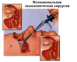 Трепанопункция лобной пазухи эффективный хирургический метод лечения фронтита