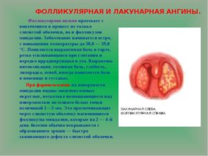 Лакунарная ангина: основные причины болезни
