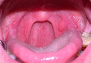 Как проявляется опухоль в горле, чем она опасна и как лечится?