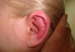 Воспаление ушной раковины: симптомы и лечение перихондрита