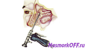 Воспаление носовых пазух: медикаментозное и хирургическое лечение