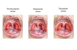 Лечение ангины у детей 3 лет: типы ангин и особенности их лечения