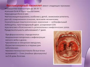 Симптомы фолликулярной ангины, а также медикаментозное, народное и хирургическое лечение