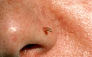 Нарост на носу у человека: виды и способы лечения