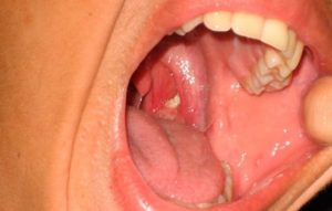 Слизь на задней стенке горла: основные причины симптома