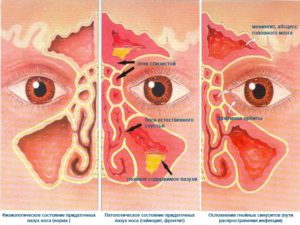 Почему постоянно заложен нос? Возможные причины и методы лечения