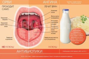 Что делать, если болит горло при беременности: причины, симптоматика и лечение