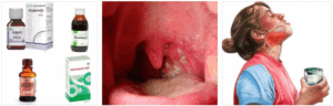 Полоскание горла Фурацилином при ангине: приготовление раствора и процедура полоскания