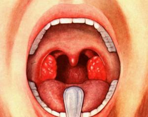 Самые эффективные методы лечения стрептококка в горле