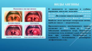 Как передается гнойная ангина и методика лечения заболевания