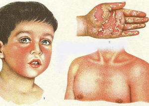 Скарлатина у детей: механизм заражения, лечение и профилактика заболевания