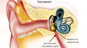 Симптомы и лечение тубоотита в домашних условиях