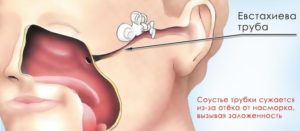 Заложенность ушей при насморке: лечение, возможные осложнения и профилактика