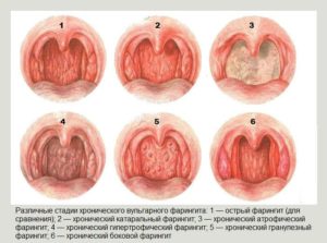 Основные симптомы ларингита и фарингита