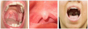 Стафилококк в горле: как проявляется и как лечить?