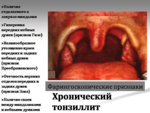 Воспаление миндалин: симптомы и возможные осложнения