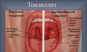 Как лечить гнойники в горле: лекарства, рецепты, операция