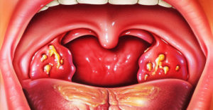 Что делать, если в горле появился гнойничок?