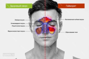 Воспаление гайморовых пазух: основные симптомы гайморита