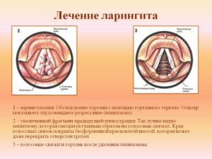Признаки ларингита и эффективные препараты для лечения заболевания гортани