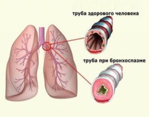 Бронхоспазм что это такое и чем он опасен?