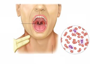 Как проявляется и чем опасна моноцитарная ангина?